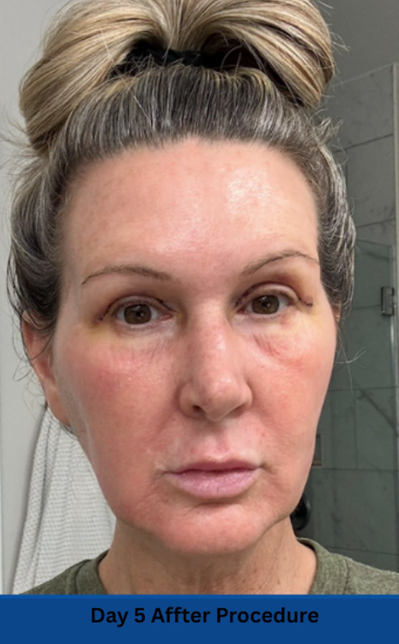 CO2 Laser Before & After Gallery - Patient 250973 - Image 7