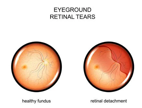 retinal tears