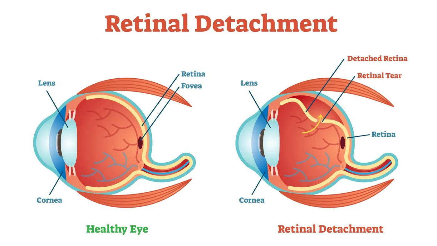retinal detachment infographic