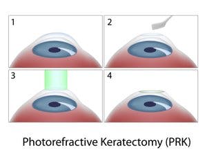 prk infographic
