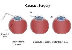 cataract surgery infographic