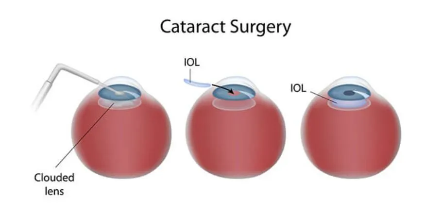 cataract surgery infographic