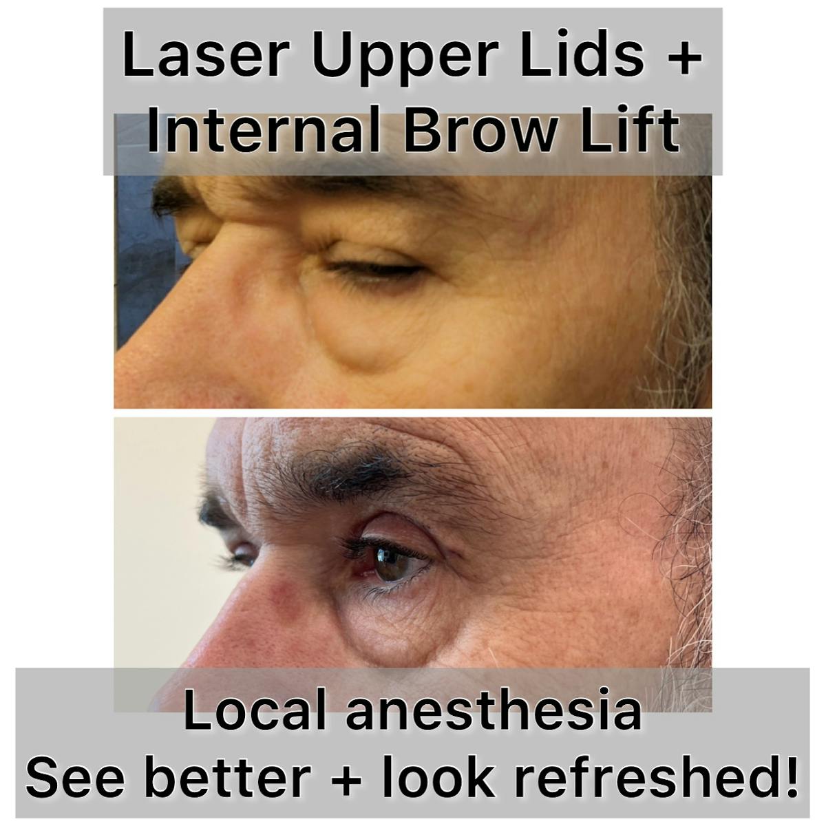 Brow Lift Before & After Gallery - Patient 389360 - Image 1