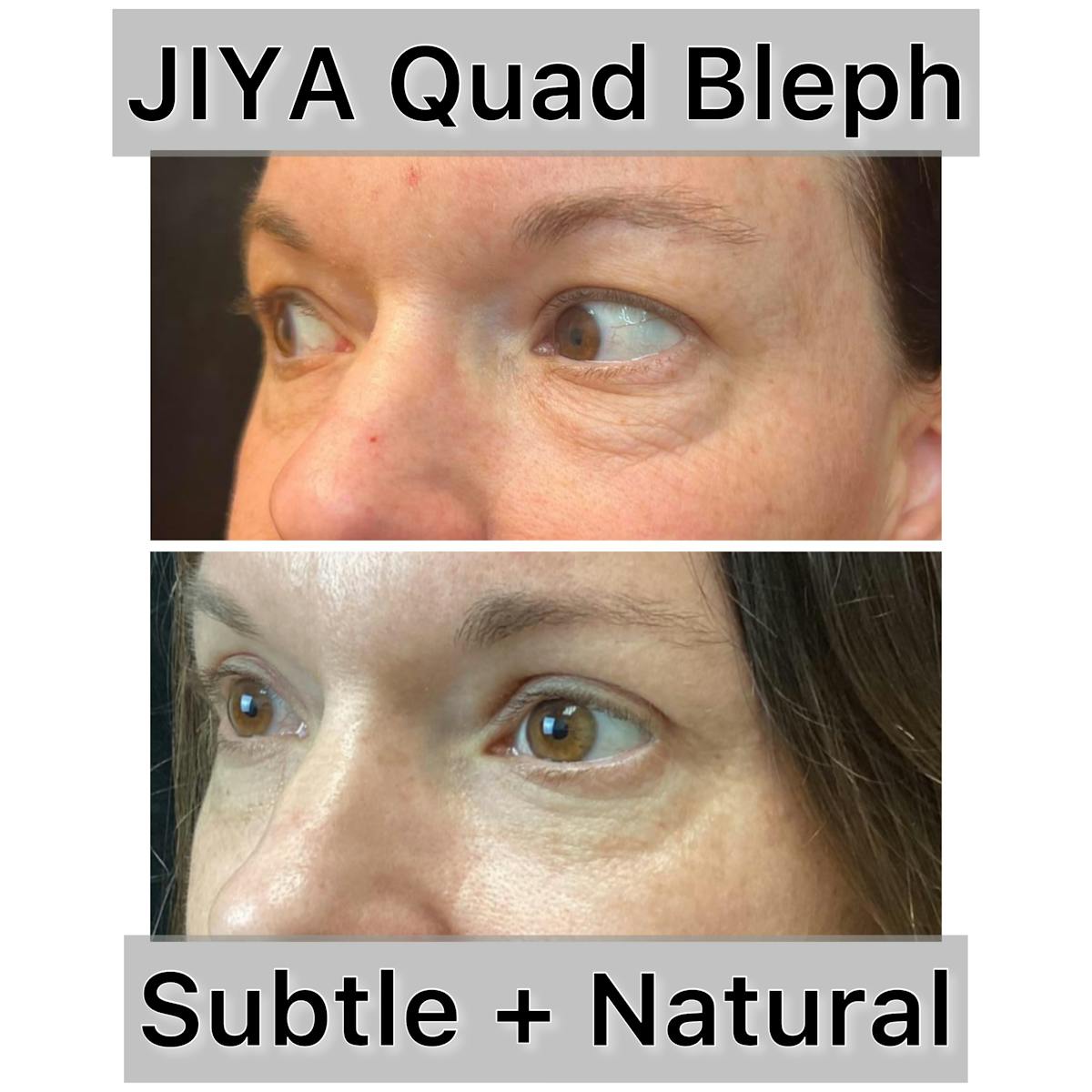 Upper and Lower Blepharoplasty Before & After Gallery - Patient 280122 - Image 1