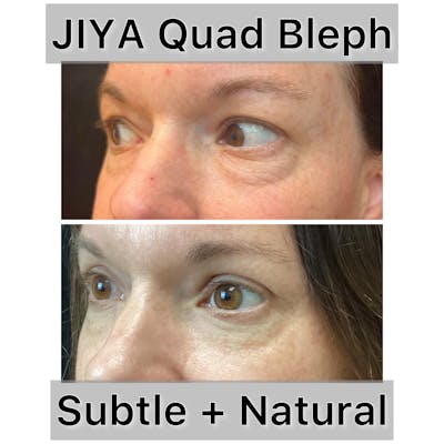 Upper and Lower Blepharoplasty Before & After Gallery - Patient 280122 - Image 1