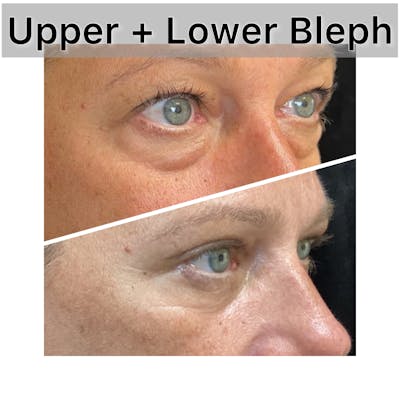 Upper and Lower Blepharoplasty Before & After Gallery - Patient 343967 - Image 1