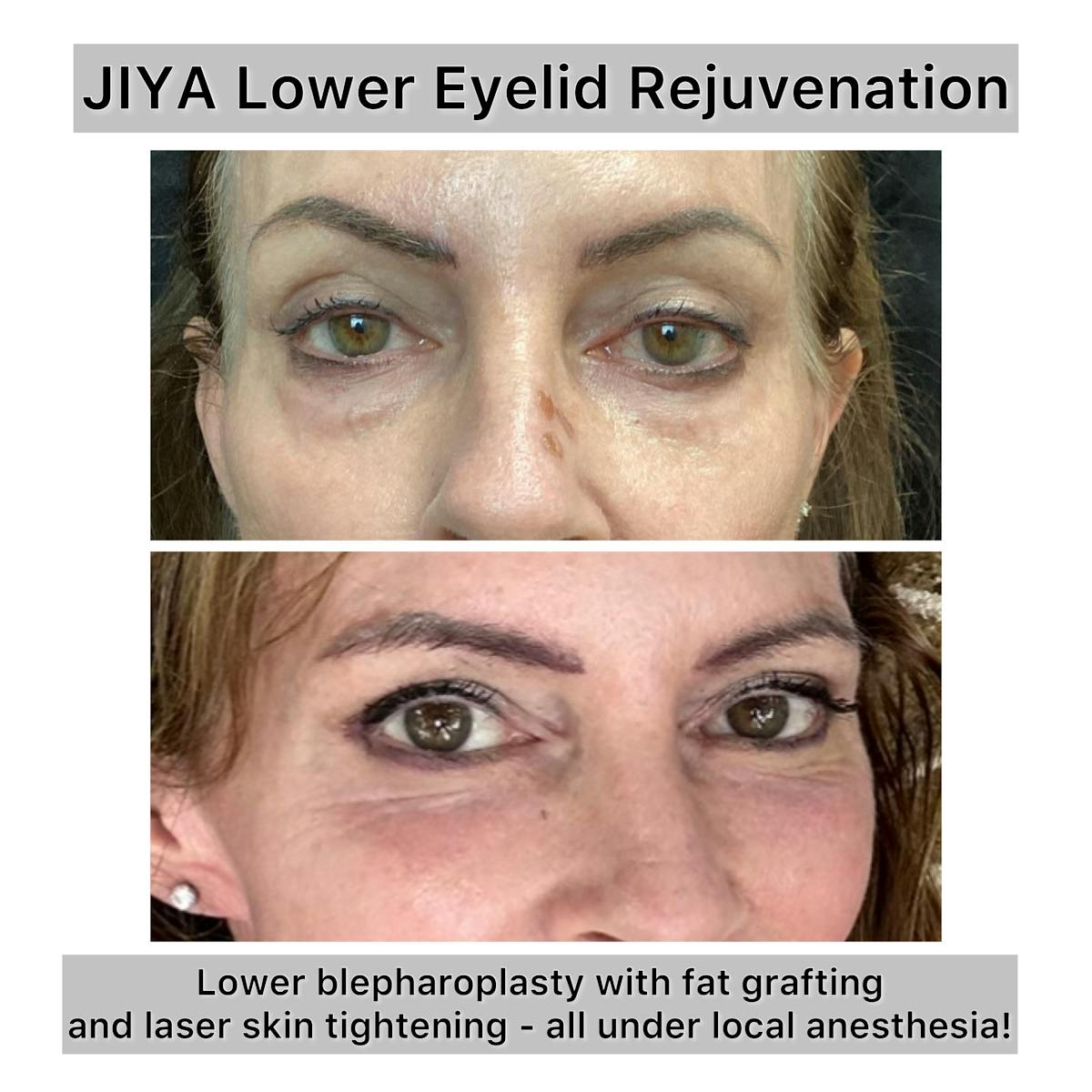 Fat Grafting Before & After Gallery - Patient 112275 - Image 1