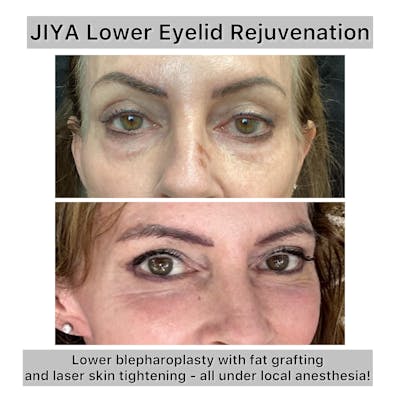 Fat Grafting Before & After Gallery - Patient 112275 - Image 1