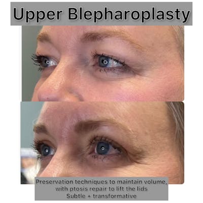 Upper Blepharoplasty Before & After Gallery - Patient 320225 - Image 1