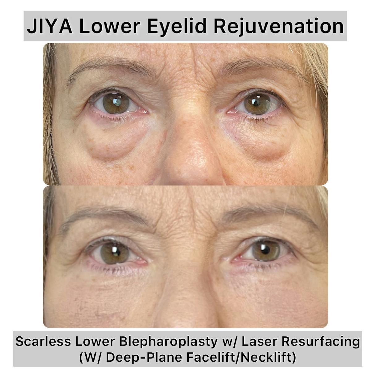 Lower Blepharoplasty Before & After Gallery - Patient 170503 - Image 1