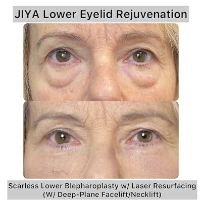 Lower Blepharoplasty Before & After Gallery - Patient 170503 - Image 1
