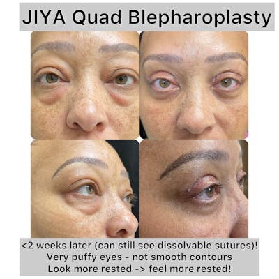Upper and Lower Blepharoplasty Before & After Gallery - Patient 262448 - Image 1