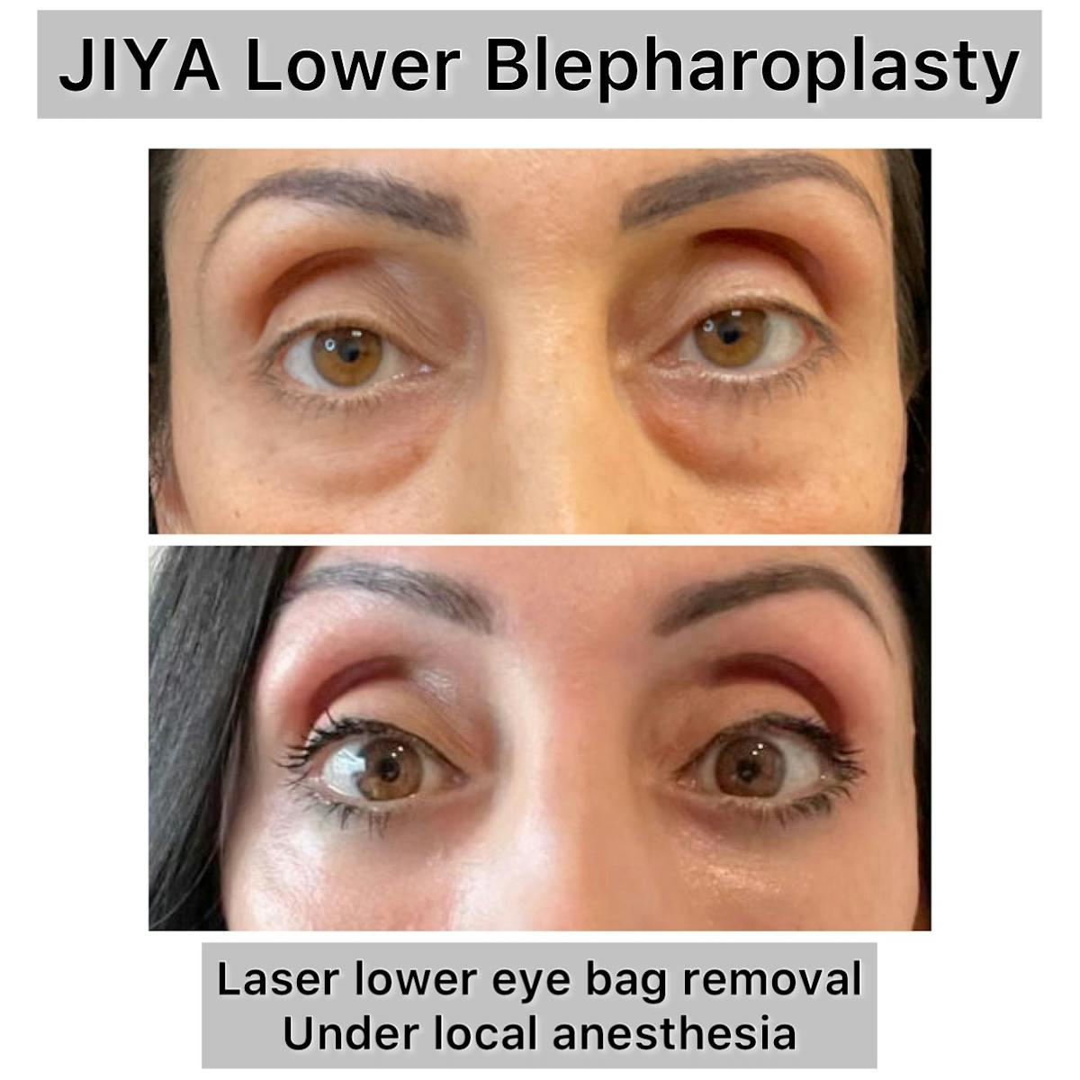 Lower Blepharoplasty Before & After Gallery - Patient 192380 - Image 1