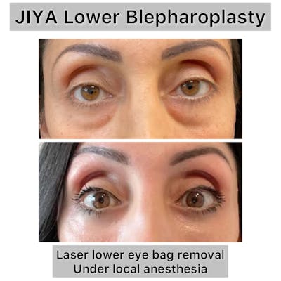 Lower Blepharoplasty Before & After Gallery - Patient 192380 - Image 1