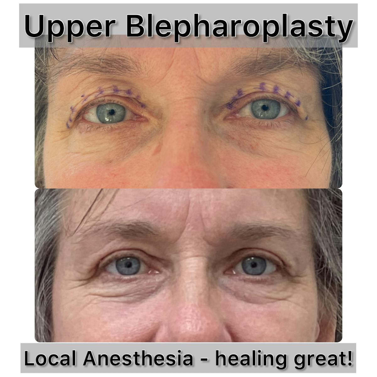 Upper Blepharoplasty Before & After Gallery - Patient 279181 - Image 1