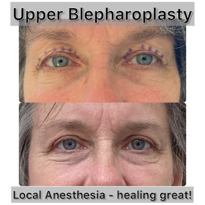 Upper Blepharoplasty Before & After Gallery - Patient 279181 - Image 1