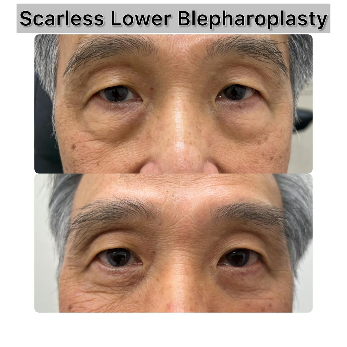 Lower Blepharoplasty Before & After Gallery - Patient 271220 - Image 1