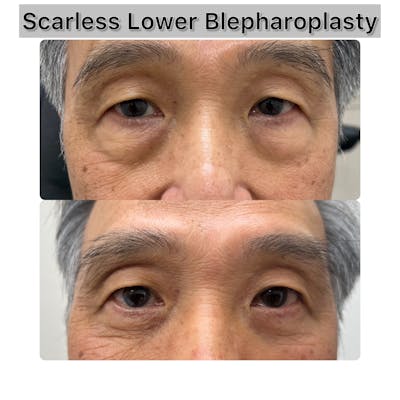 Lower Blepharoplasty Before & After Gallery - Patient 271220 - Image 1