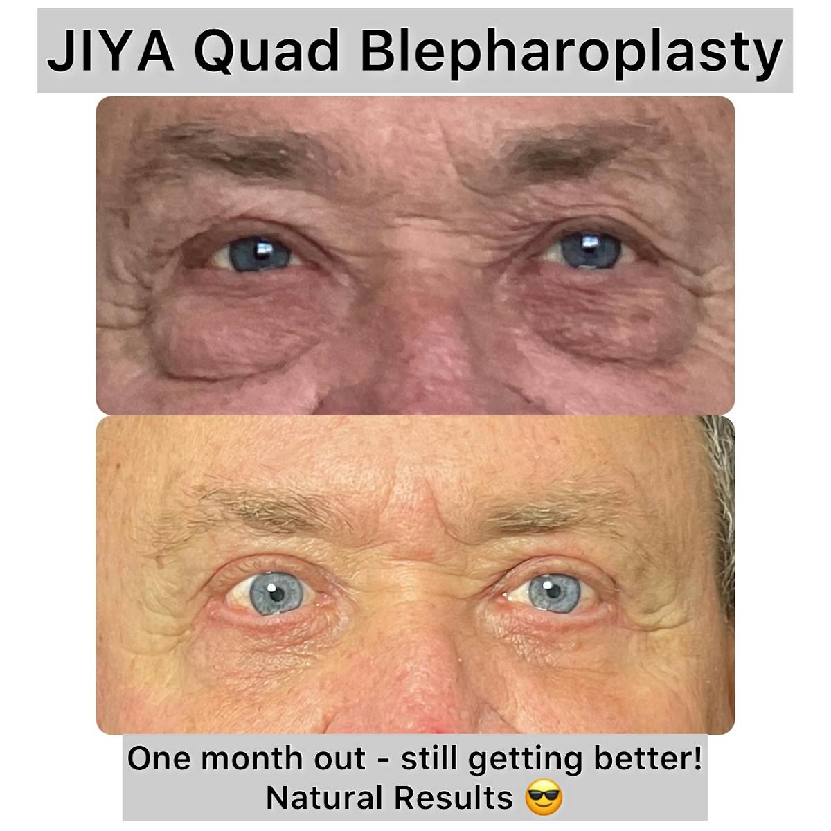 Upper and Lower Blepharoplasty Before & After Gallery - Patient 111165 - Image 1