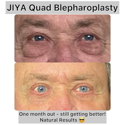 Upper and Lower Blepharoplasty Before & After Gallery - Patient 111165 - Image 1
