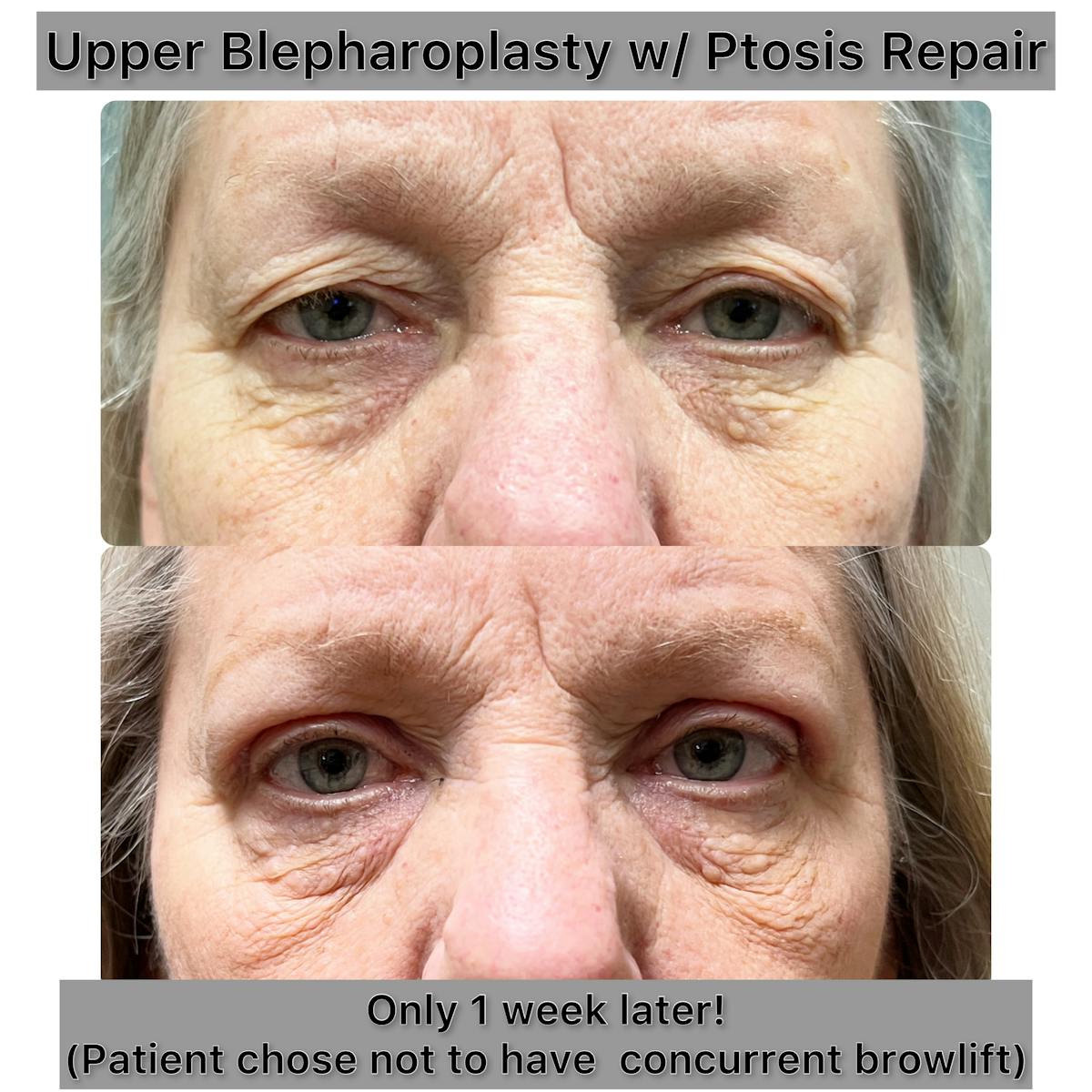 Upper Blepharoplasty Before & After Gallery - Patient 193540 - Image 1