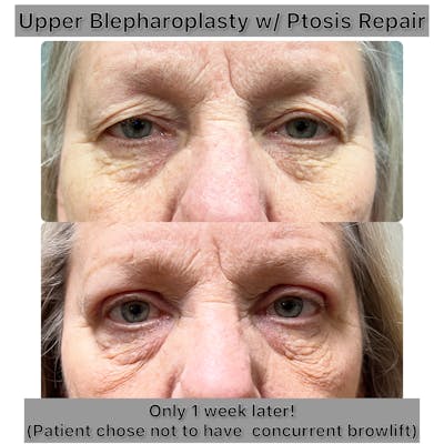 Upper Blepharoplasty Before & After Gallery - Patient 193540 - Image 1