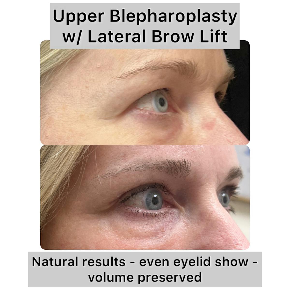 Upper Blepharoplasty Before & After Gallery - Patient 412667 - Image 1