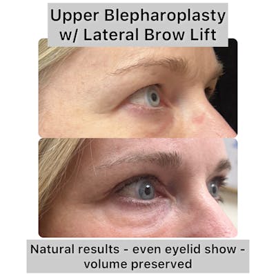 Upper Blepharoplasty Before & After Gallery - Patient 412667 - Image 1