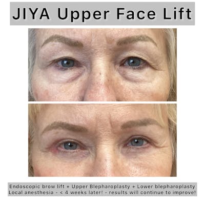 Upper and Lower Blepharoplasty Before & After Gallery - Patient 261590 - Image 1