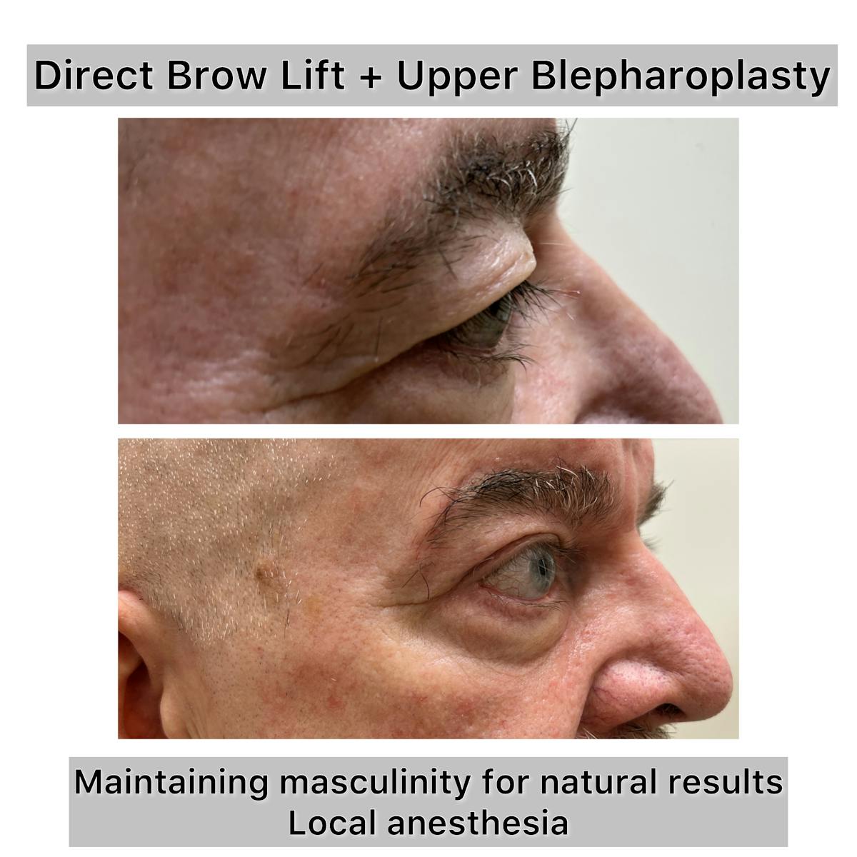Upper Blepharoplasty Before & After Gallery - Patient 351584 - Image 1