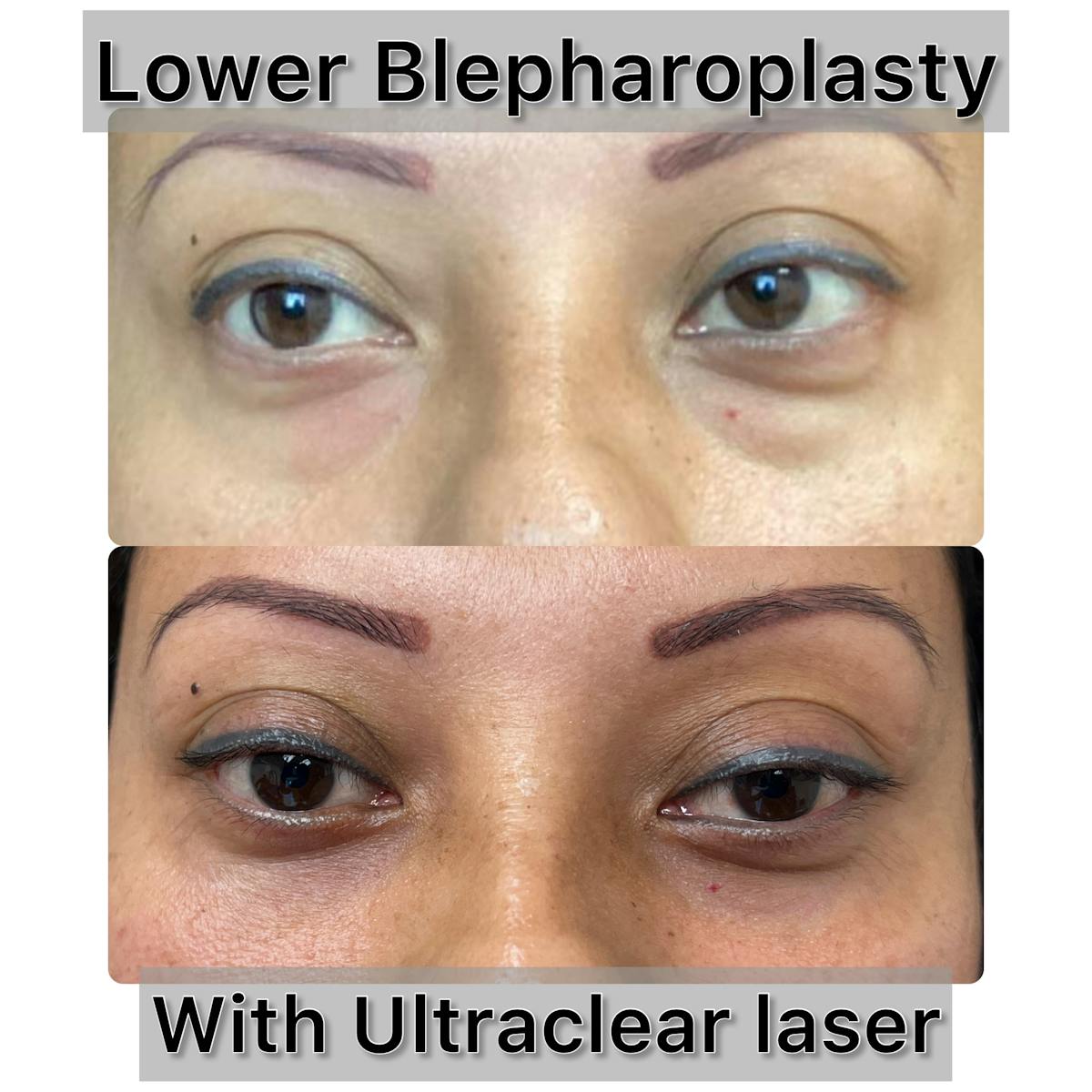 Lower Blepharoplasty Before & After Gallery - Patient 256475 - Image 1