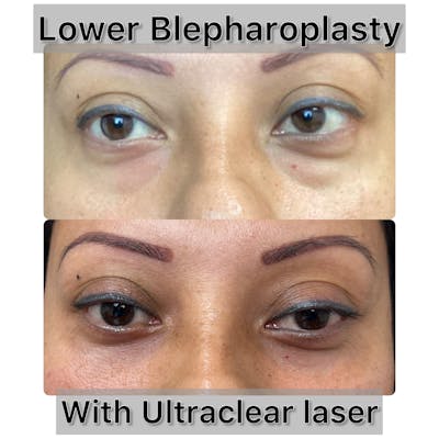 Lower Blepharoplasty Before & After Gallery - Patient 256475 - Image 1