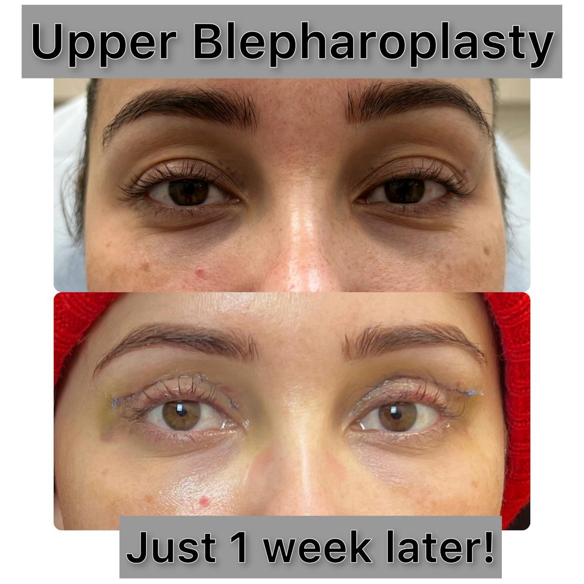 Upper Blepharoplasty Before & After Gallery - Patient 227067 - Image 1