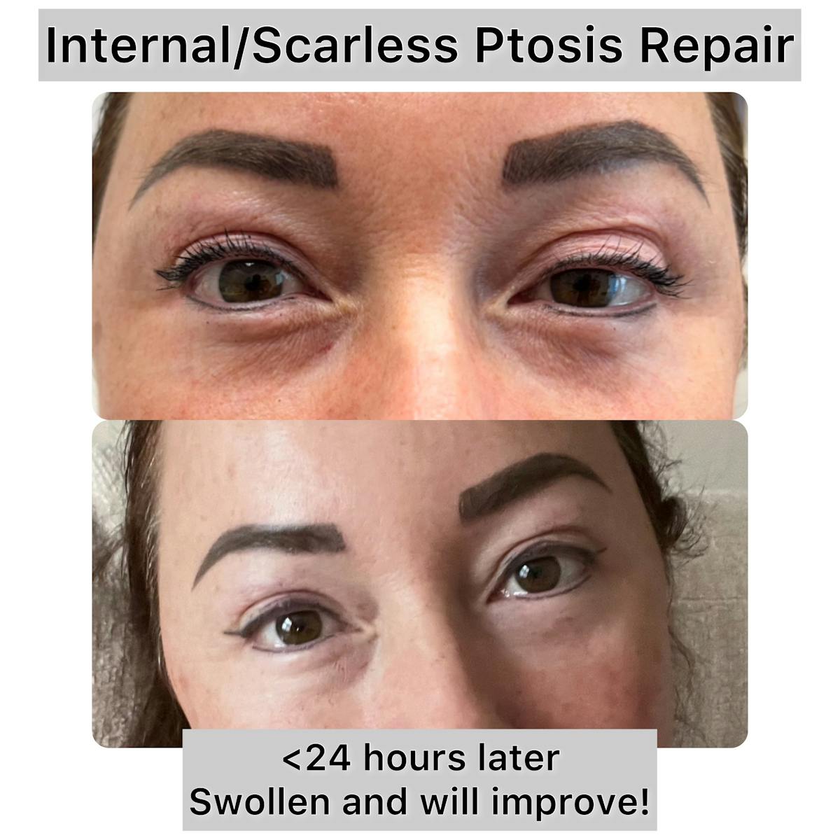Ptosis Repair Before & After Gallery - Patient 364094 - Image 1