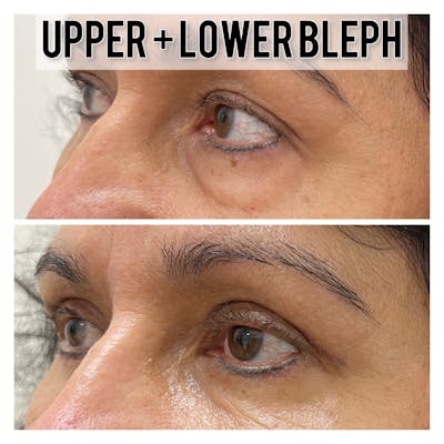 Upper and Lower Blepharoplasty Before & After Gallery - Patient 136436 - Image 1