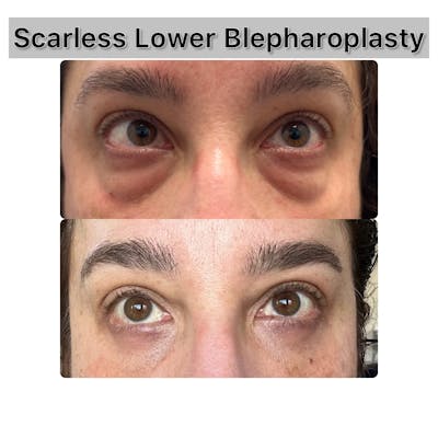 Lower Blepharoplasty Before & After Gallery - Patient 139937 - Image 1