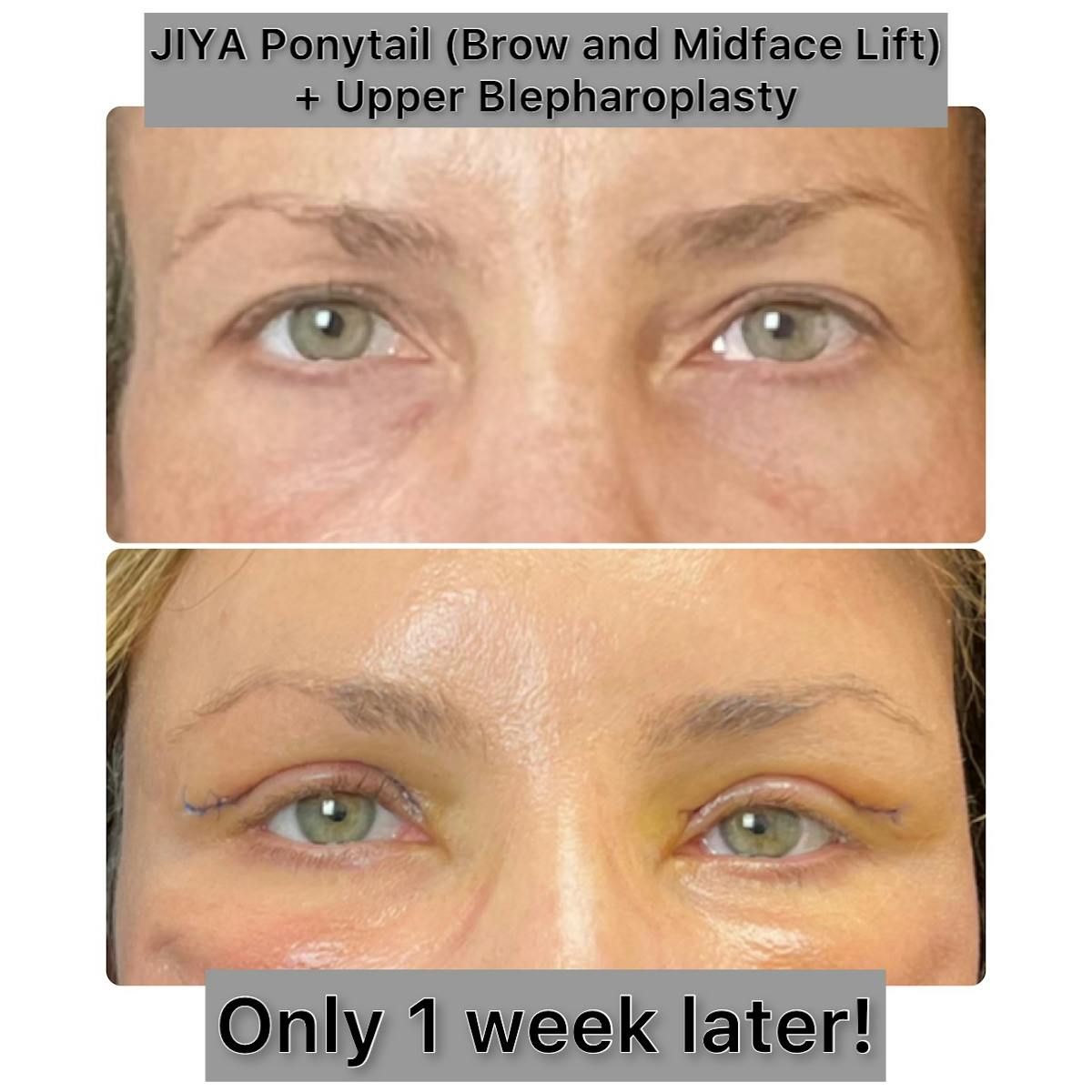 Upper Blepharoplasty Before & After Gallery - Patient 114607 - Image 1