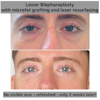 Fat Grafting Before & After Gallery - Patient 190417 - Image 1