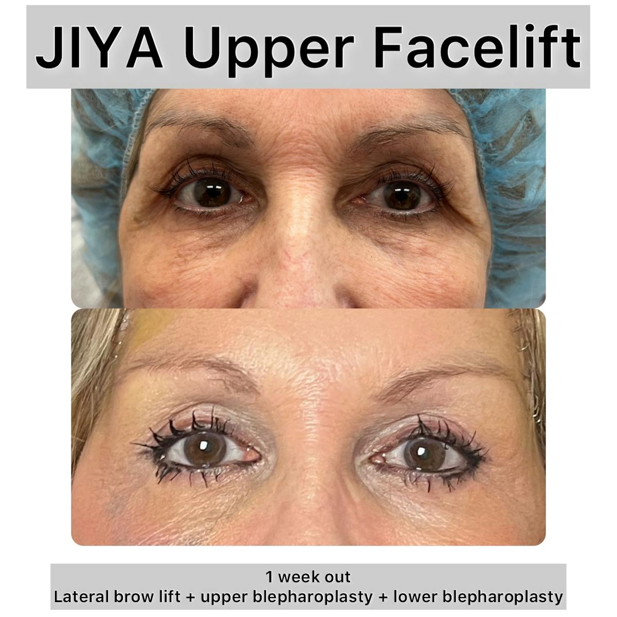 Upper and Lower Blepharoplasty Before & After Gallery - Patient 303479 - Image 1