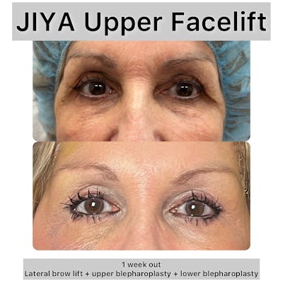 Upper and Lower Blepharoplasty Before & After Gallery - Patient 303479 - Image 1