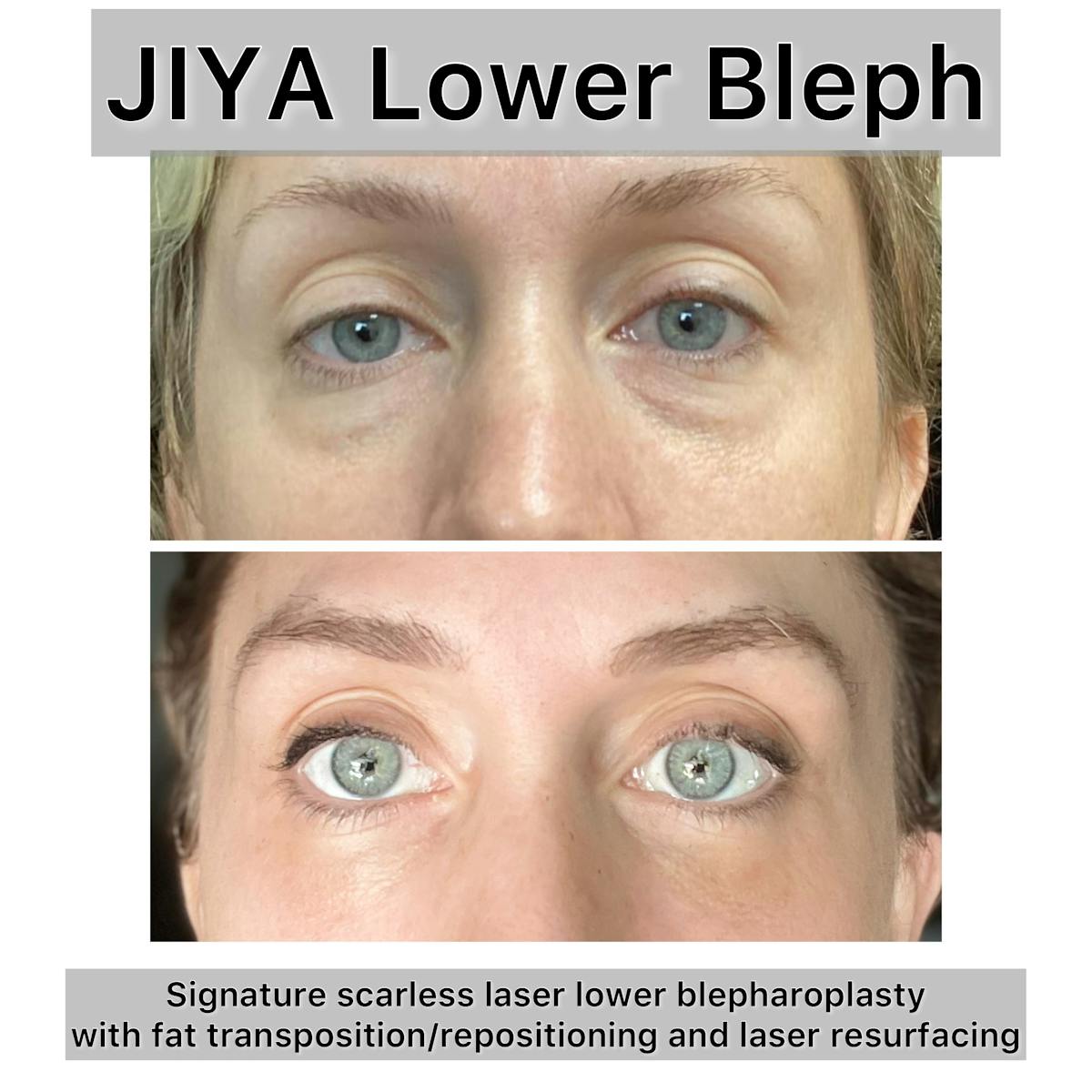 Lower Blepharoplasty Before & After Gallery - Patient 373058 - Image 1