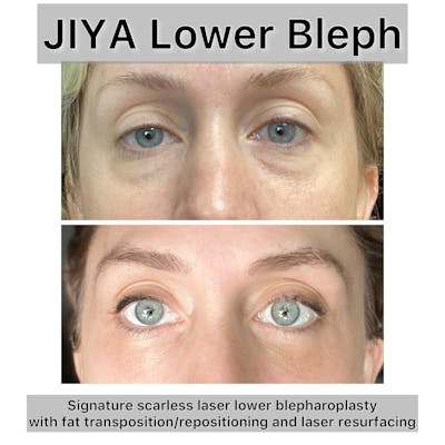 Lower Blepharoplasty Before & After Gallery - Patient 373058 - Image 1