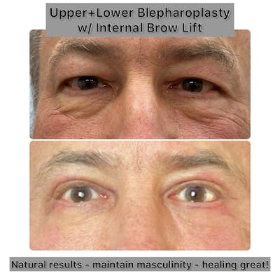 Upper and Lower Blepharoplasty Before & After Gallery - Patient 303803 - Image 1