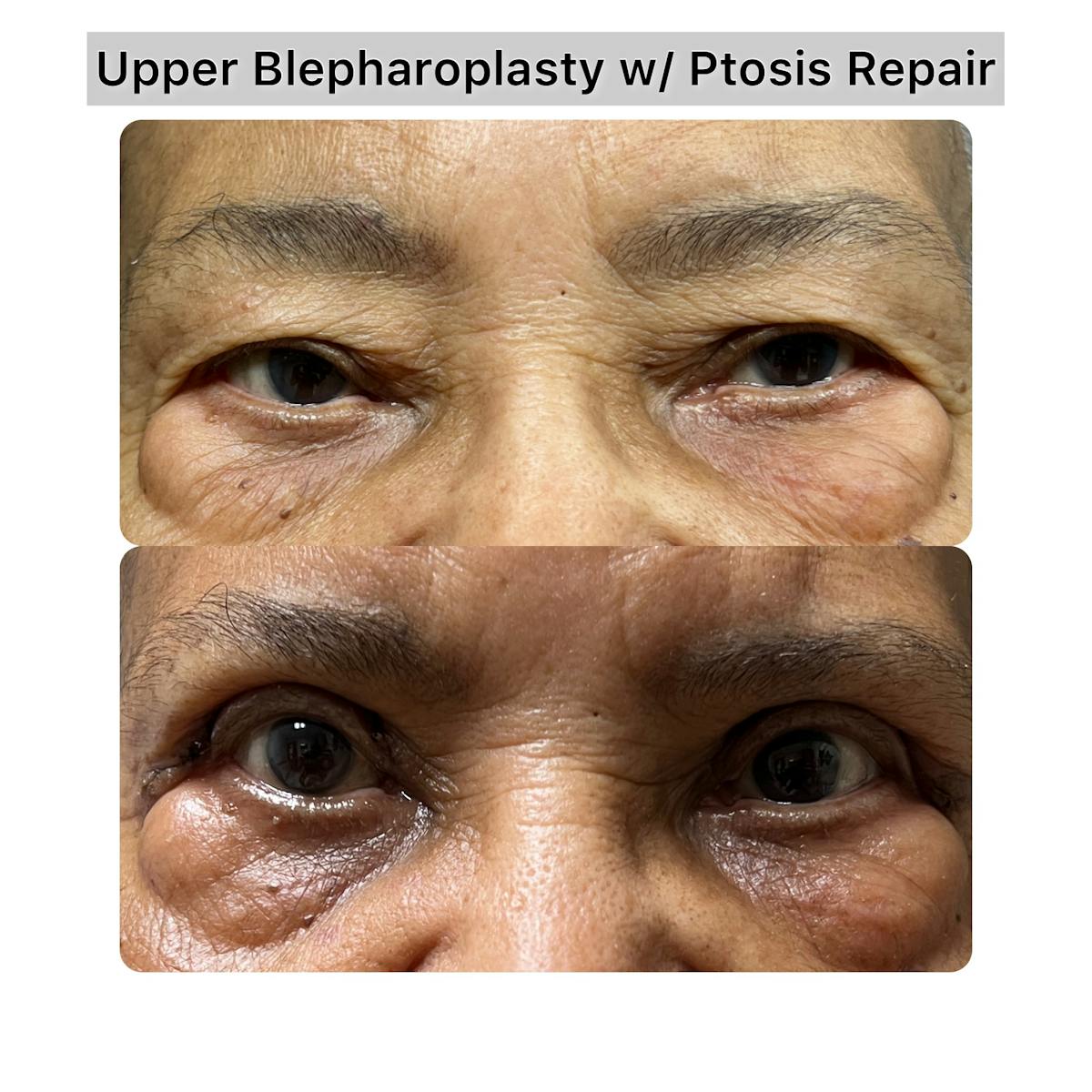 Upper Blepharoplasty Before & After Gallery - Patient 365889 - Image 1