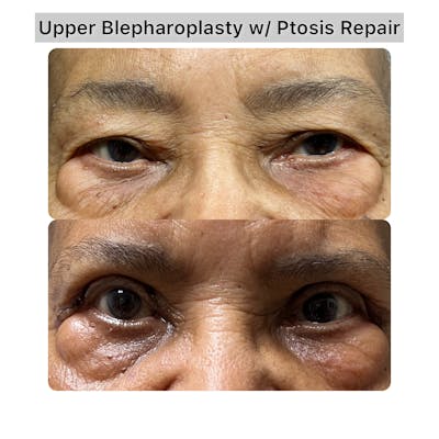 Upper Blepharoplasty Before & After Gallery - Patient 365889 - Image 1