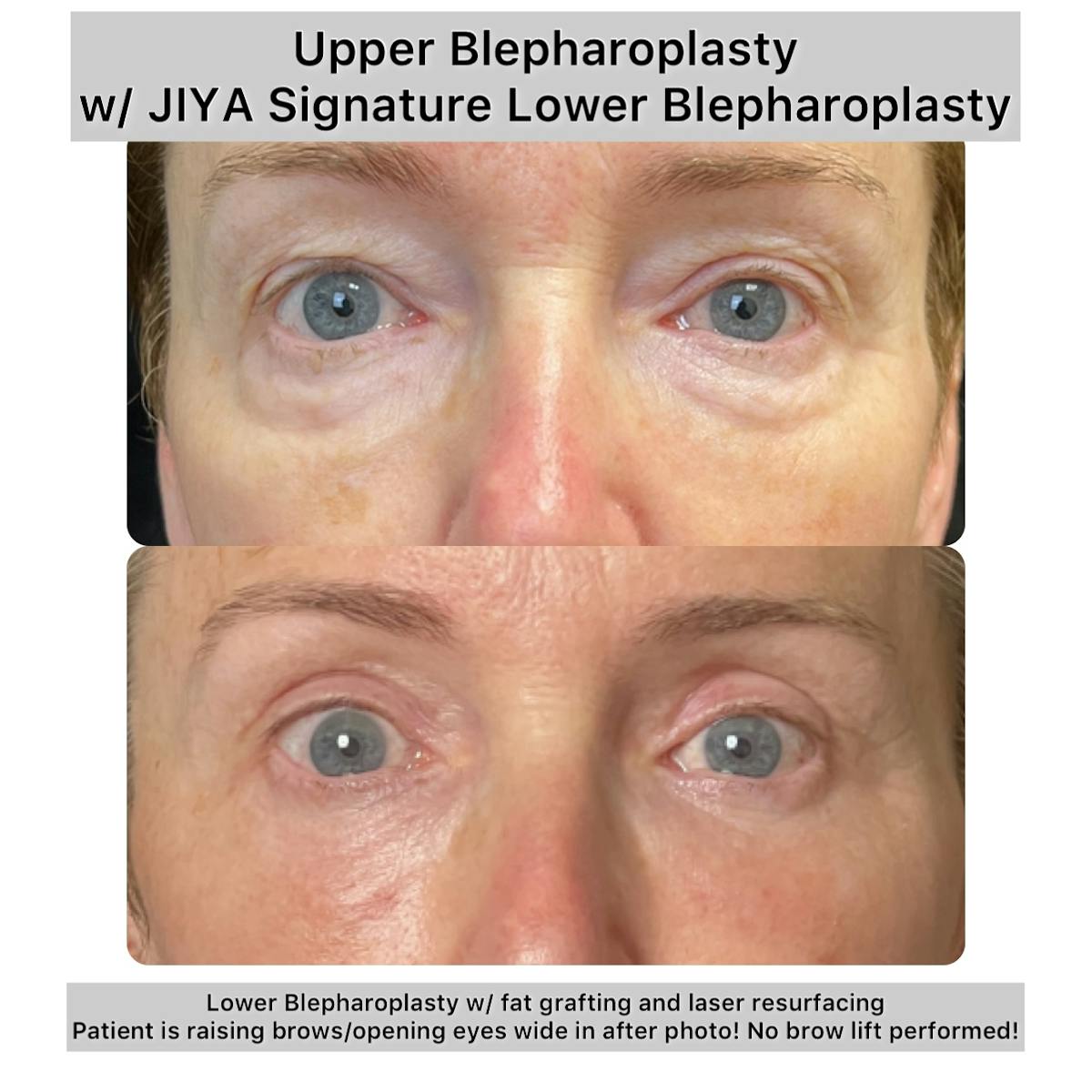Upper and Lower Blepharoplasty Before & After Gallery - Patient 269076 - Image 1