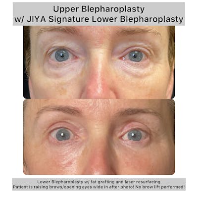 Upper and Lower Blepharoplasty Before & After Gallery - Patient 269076 - Image 1