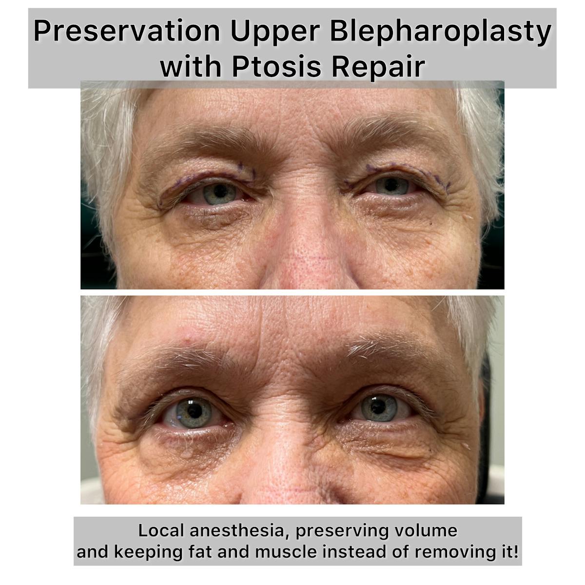 Upper Blepharoplasty Before & After Gallery - Patient 116706 - Image 1