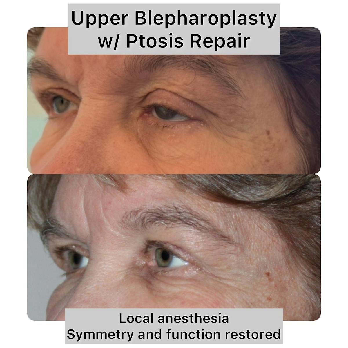 Ptosis Repair Before & After Gallery - Patient 183665 - Image 1
