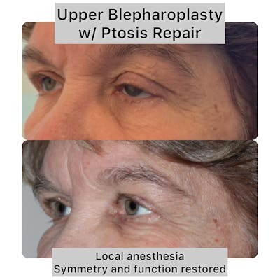 Upper Blepharoplasty Before & After Gallery - Patient 370711 - Image 1